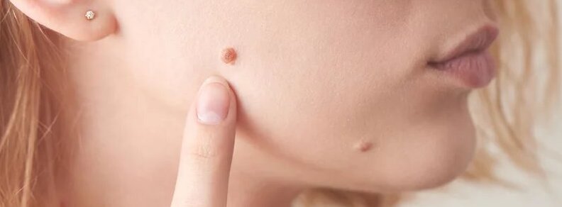 ¿Los lunares de carne pueden llegar a ser cancerígenos?